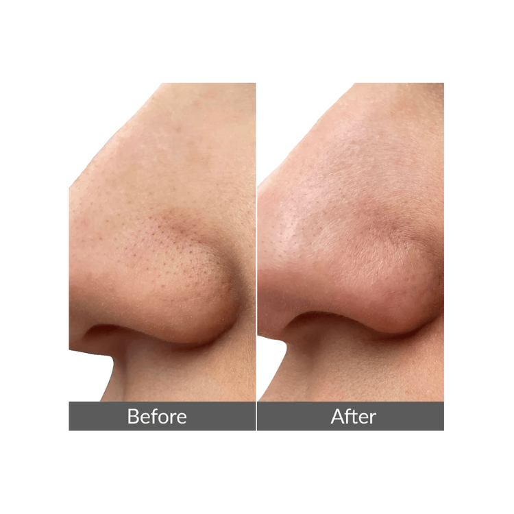 Wave Pro Limpiador facial extracción de puntos negros y espinillas