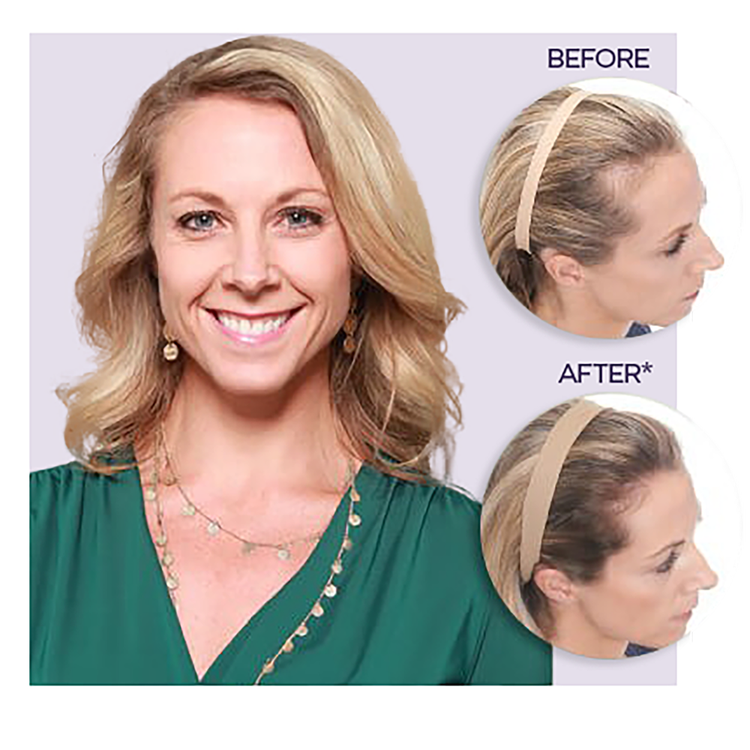 Hair Regrowth Sprayer for Women - 30 Day Supply Tratamiento capilar ayuda a regenerar el cabello