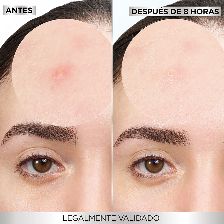 Pimple Patches - Parches hidrocoloides, para acné