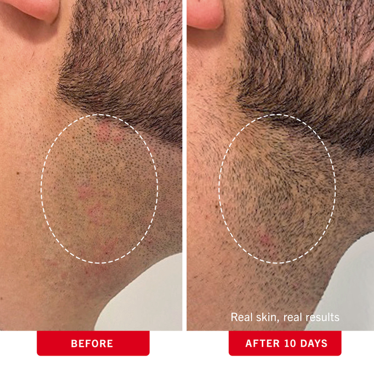 Ingrown Hair Pads with BHA & AHA - Toallitas para vellos encarnados, exfolia la piel