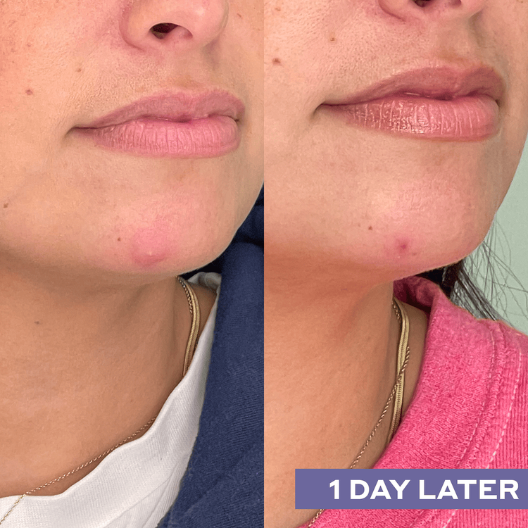 Hypochlorous Acid Spray facial reparador limpia las impurezas