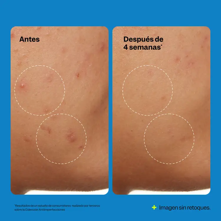 Blemish Claryfing - Limpiador para acné, limpieza profunda