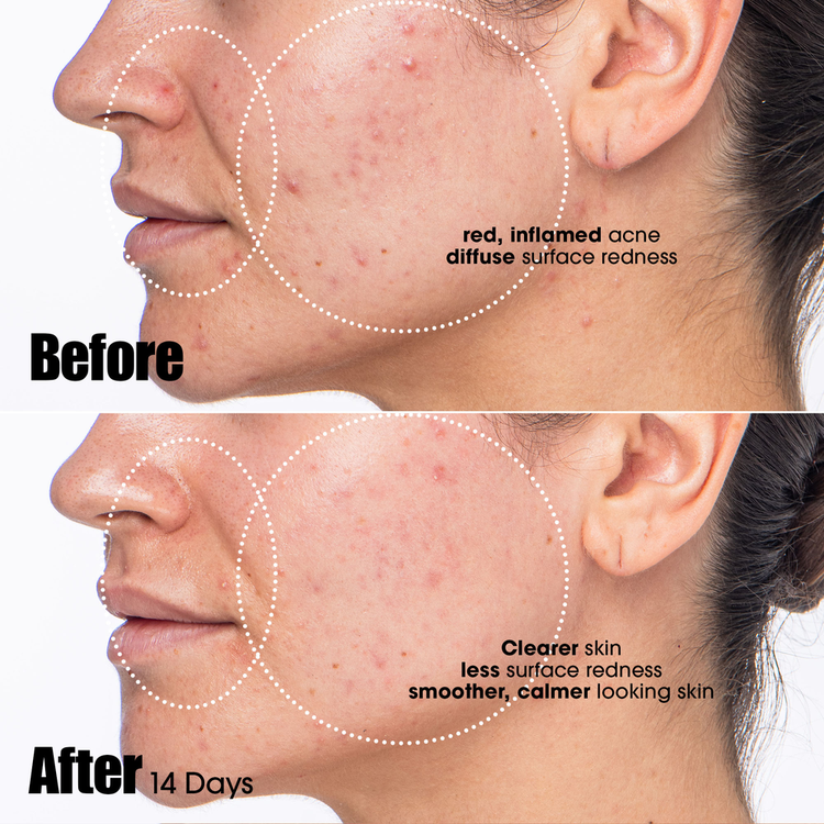 Peace Keeper Treatment Suero calma la piel irritada