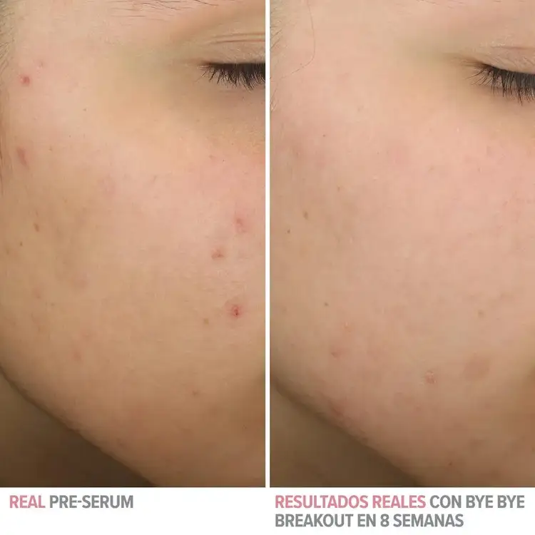 Bye Bye Serum - Suero facial, tratamiento anti-acné