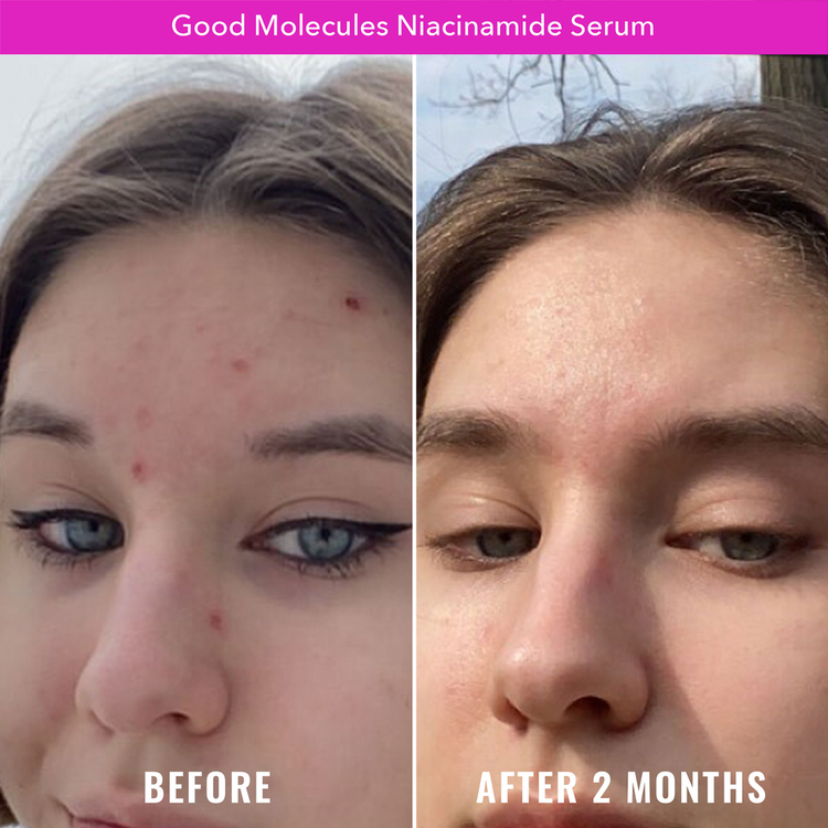 Niacinamide - Suero facial, minimiza poros y unifica el tono y textura de la piel