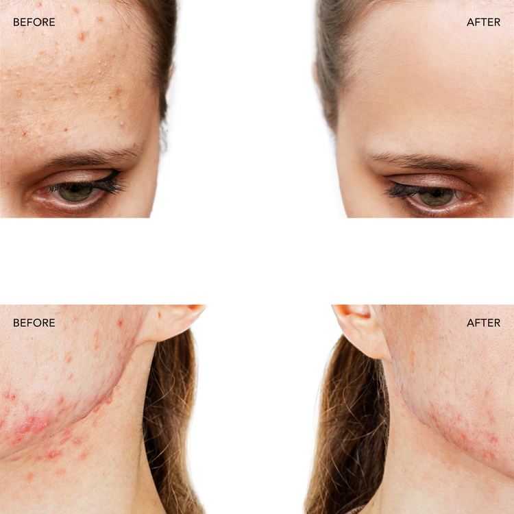 Espada 2 Dispositivo de tratamiento con luz led azul