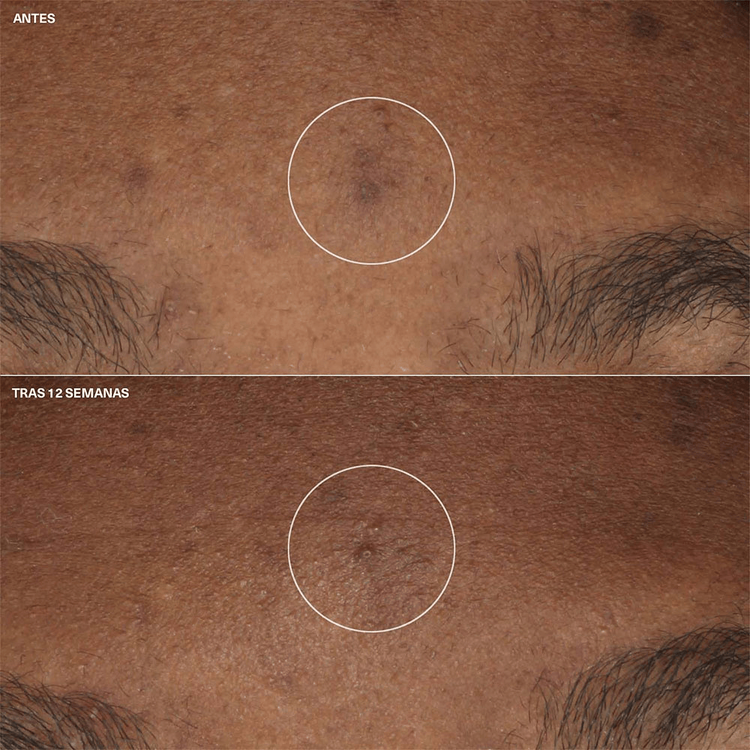 Even Better Brigthening Moisturizer Crema facial hidrata y ayuda a despigmentar la piel