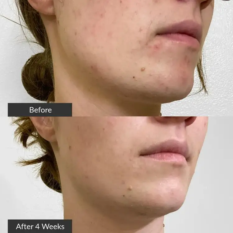 Clean Acne Cepillo facial limpia suciedad, maquillaje y contaminación