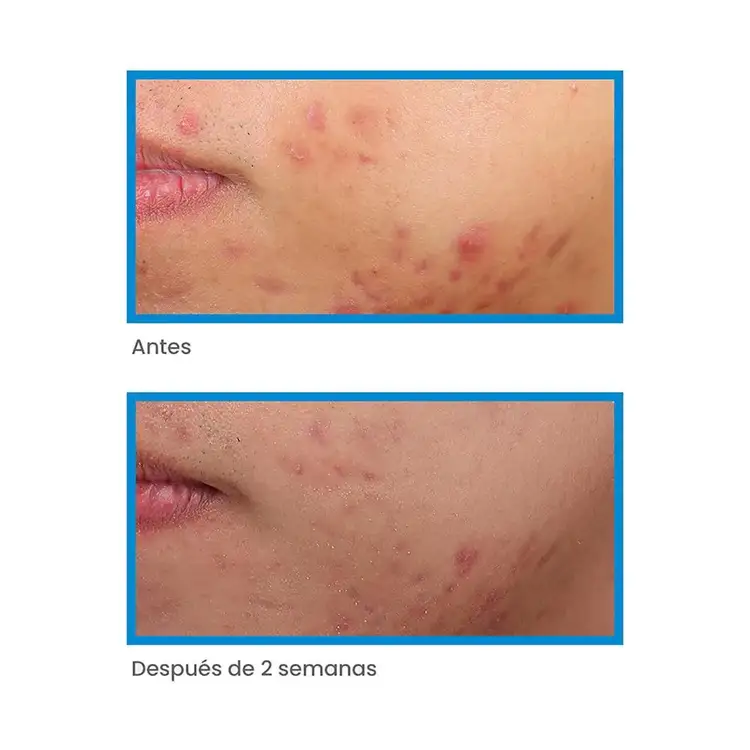 Acné - Deep Relief Blemish Treatment Tratamiento para acné serum limpiador antiacné potente
