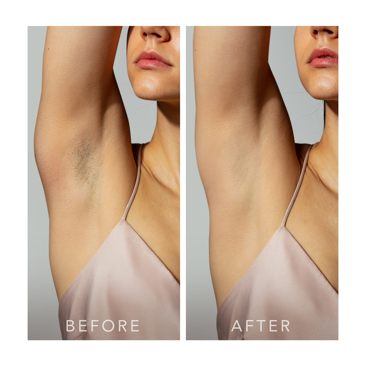 Peach 2 Depiladora ipl para depilación permanente