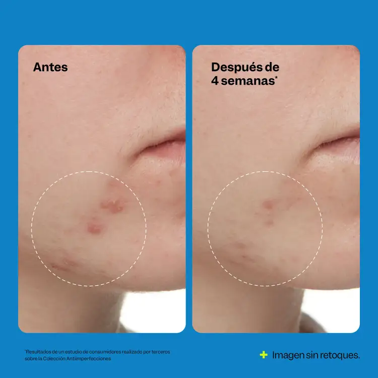Blemish Exfoliating - Tónico exfoliante, limpia y previene el acné