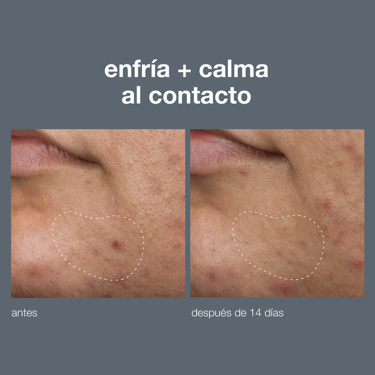 Deep Acne Invisible Liquid Patch Parches líquido invisible para acné profundo previene brotes de acné