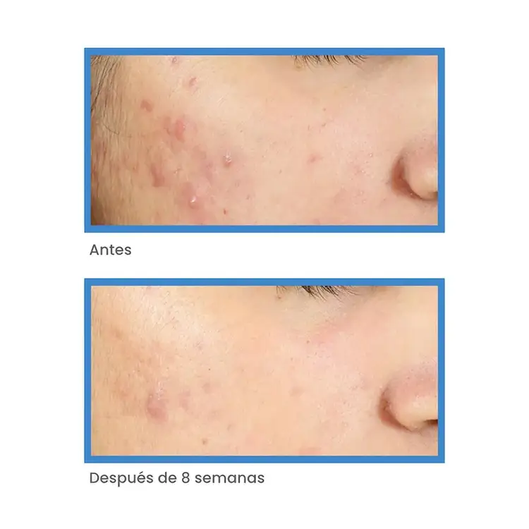 Acné - Invisiscar Treatment Tratamiento elimina cicatrices y marcas