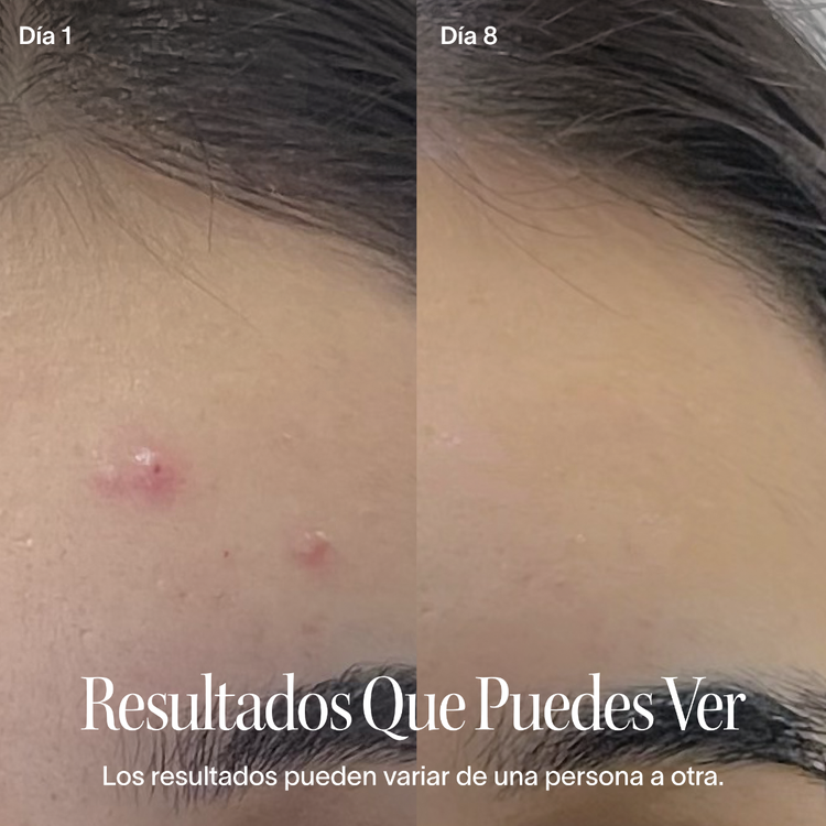 Bye Acne - Terapia de luz azul + roja, para el tratamiento del acné