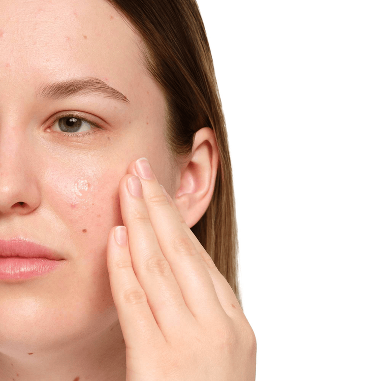 Ácido Salicílico 2% - Suero facial, combate el acné y reduce imperfecciones