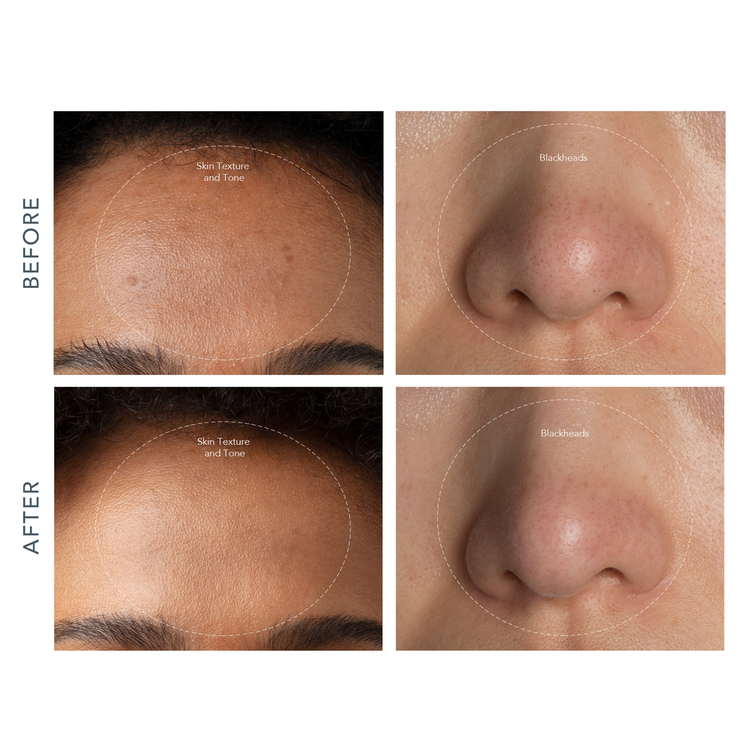 Kiwi Aspirador purificante de puntos negros para todo tipo de piel