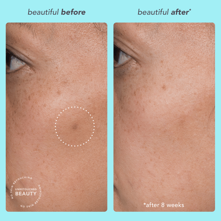 Dark Spot Serum 7% Pro-Niacinamide Suero combate el acné