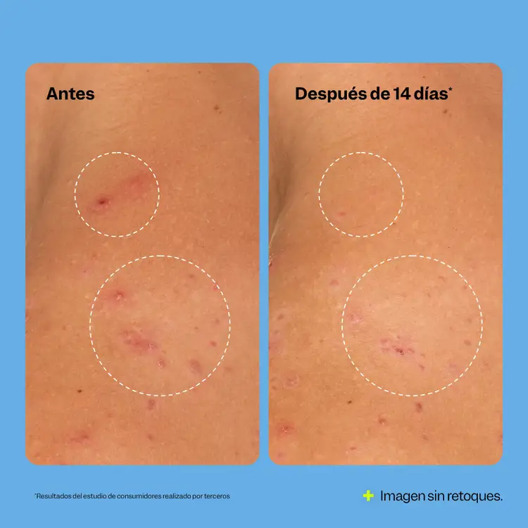 Breakout Banisher - Spray corporal, hidrata y suaviza la piel