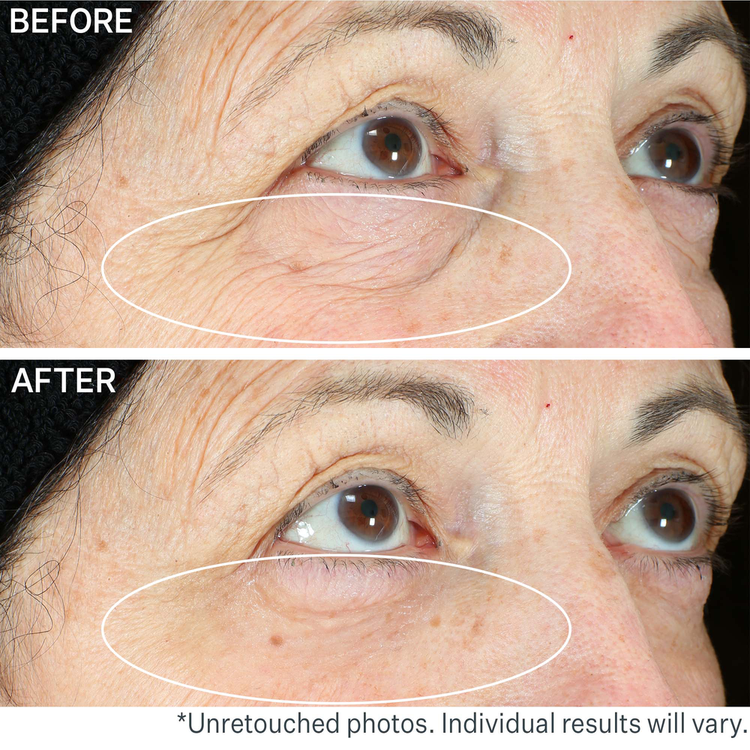 Hyperlift Eye Instant Eye Fix For Bags, Lines & Crepiness Tratamiento reafirma la zona de los ojos