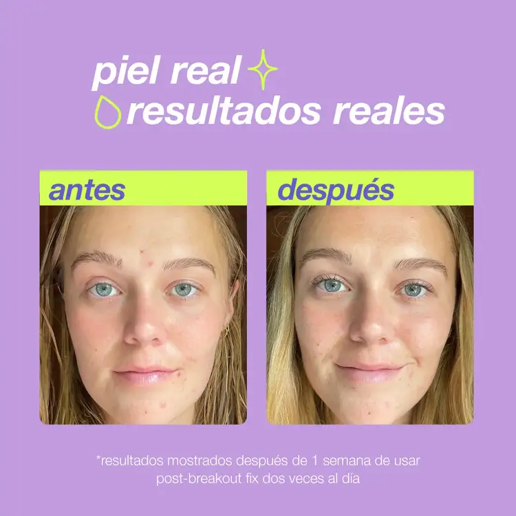 Clear Start Post-Breakout Fix Dark Spot Treatment Tratamiento para manchas post-brote rápida restauración