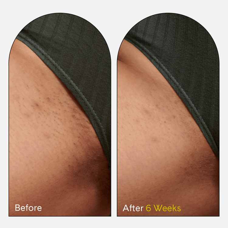 Ingrown Eliminator Suero en roller calma la piel