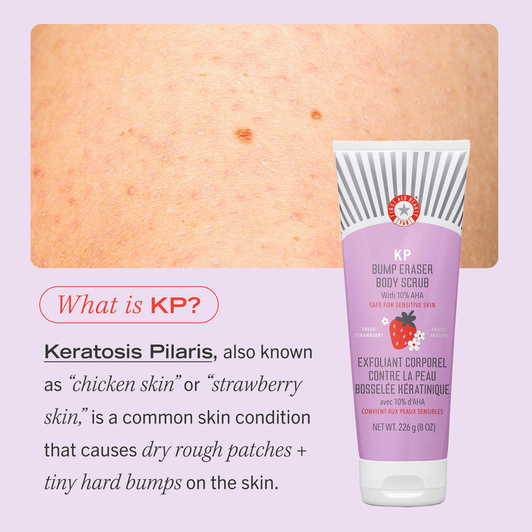 KP Bump Eraser Body Scrub Fresh Strawberry Exfoliante corporal, tamaño para viaje