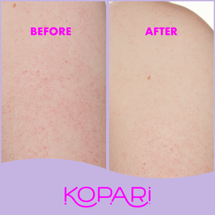 Body Bumps Be Gone - Tratamiento exfoliante corporal, reduce queratosis
