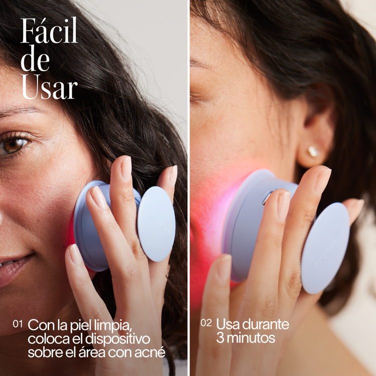 Bye Acne - Terapia de luz azul + roja, para el tratamiento del acné