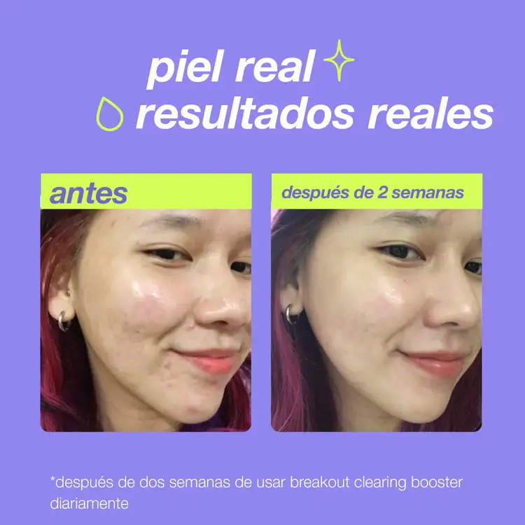 Clear Start Breakout - Tratamiento potenciador antibrotes, previene brotes de acné