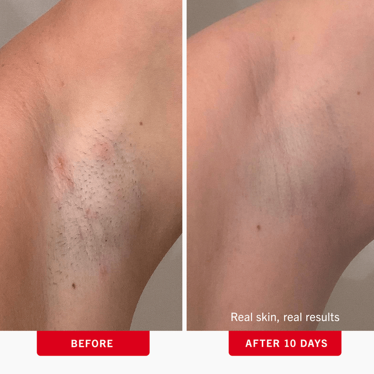 Ingrown Hair Pads with BHA & AHA - Toallitas para vellos encarnados, exfolia la piel