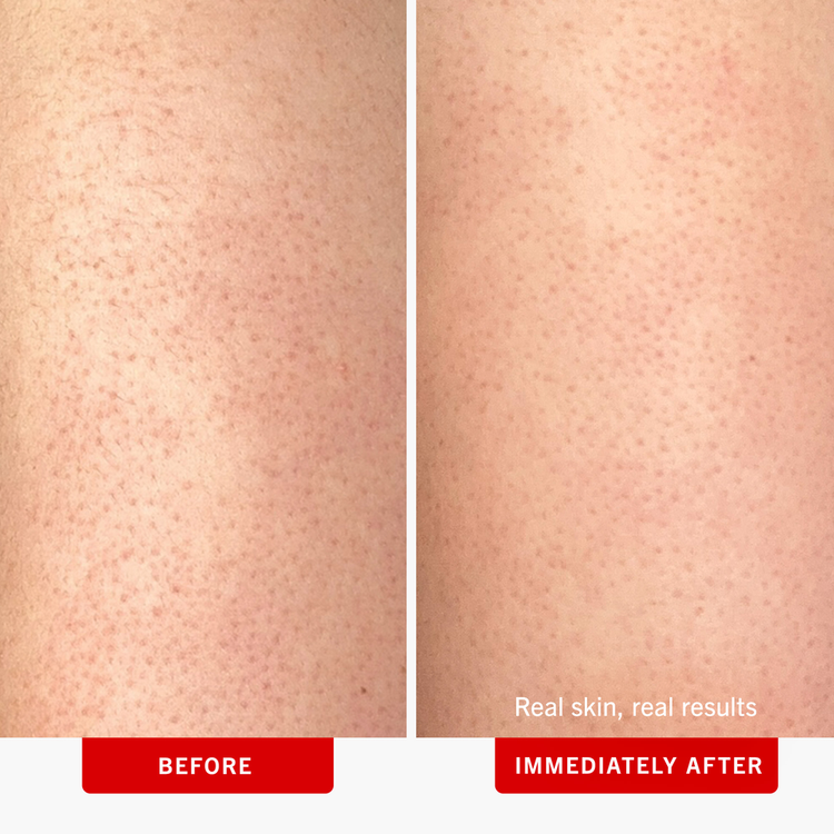 KP Bump Eraser - Exfoliante corporal con 10% de AHA, reduce la apariencia de los granitos