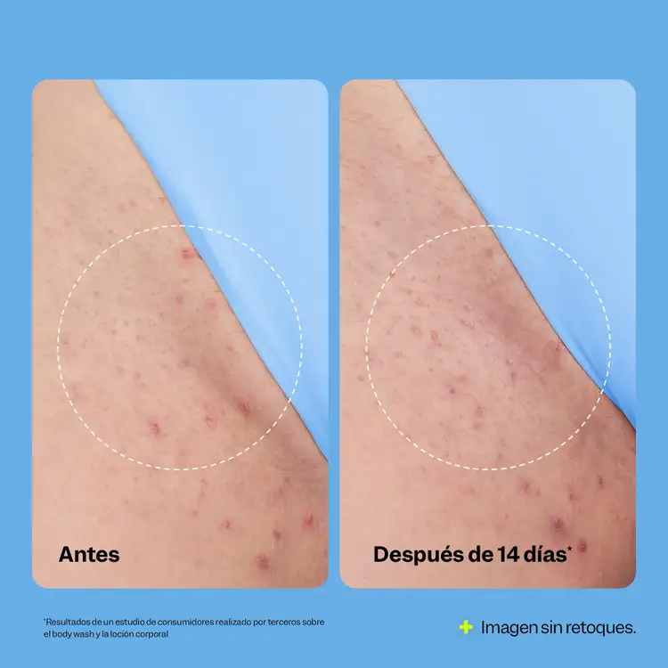 Smoothing Solution - Rodillo facial, tatamiento para vellos encarnados