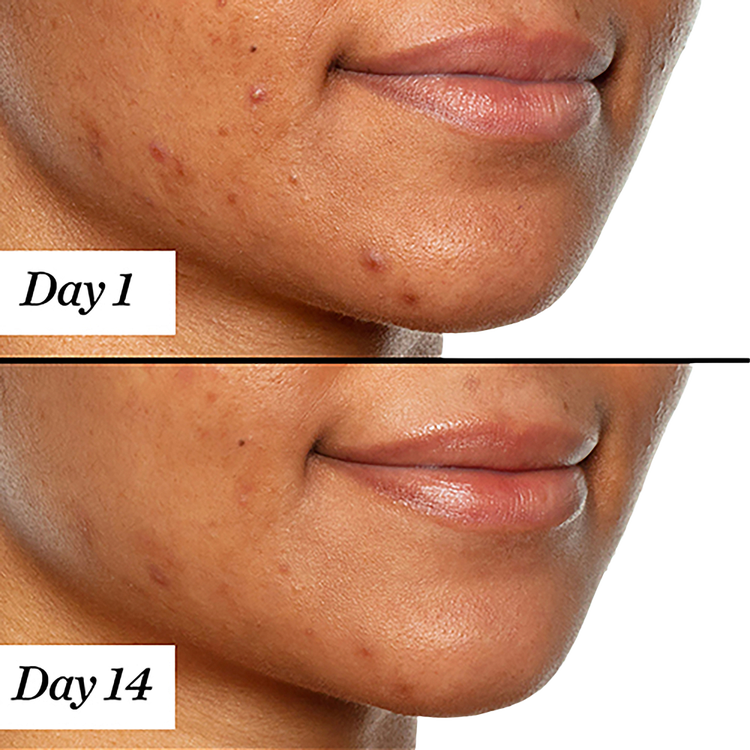 U.F.O. Ultra-Clarifying Acne Treatment Aceite facial limpia las impurezas