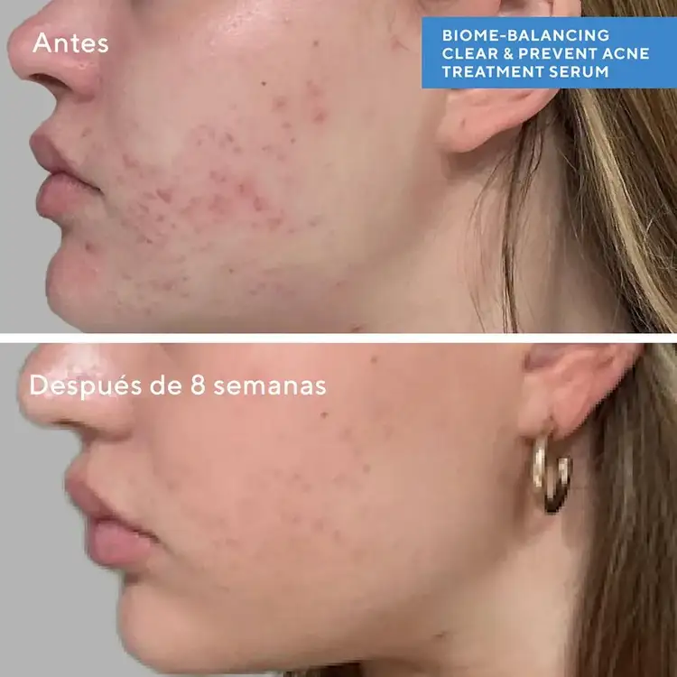 Biome-Balancing Clear & Prevent Blemish Treatment Serum Tratamiento en suero hidratación + protección solar